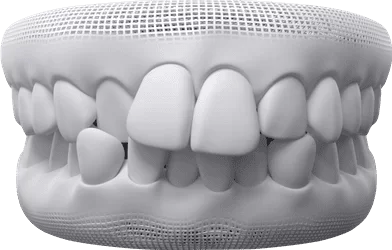 Generally Crowded Teeth