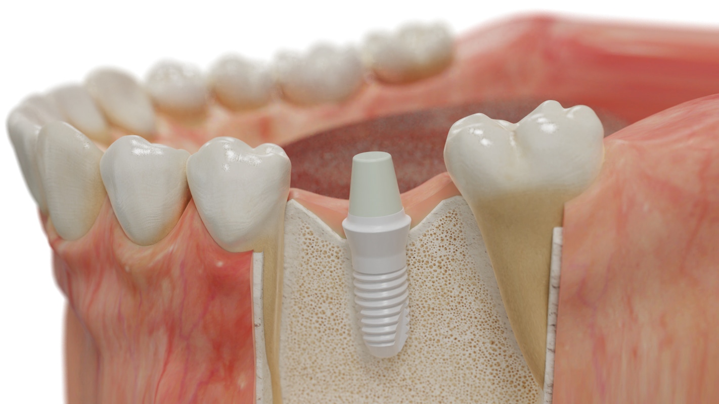 Ceramic dental implants