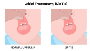 a diagram showing a child with a lip tie