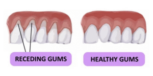 diagram of receding gums