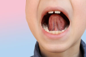 a close up image of a young children lifting his tongue to show a tongue tie